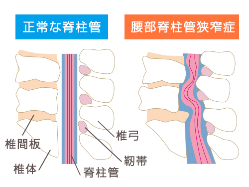 腰部脊柱管狭窄症とは